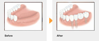 1本のインプラント