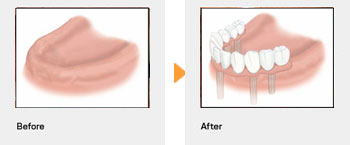 フルのインプラント