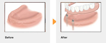 フルのインプラント