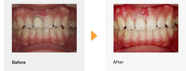 オールセラミック