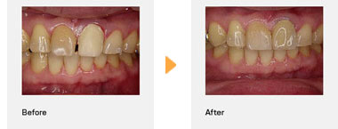 ラミネートベニア