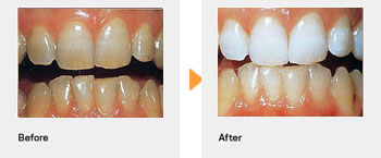 ホワイトニング